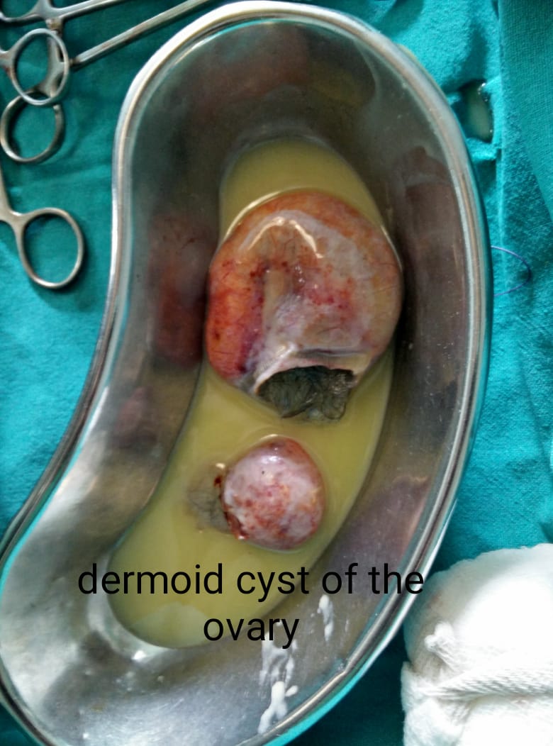 Dermoid cyst of the ovary | Dr. Ruchi Tandon