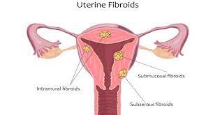 Uterine Fibroids - Dos and Don’ts