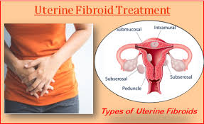 Lifestyle Modifications to Reduce Fibroid Growth and Recurrence