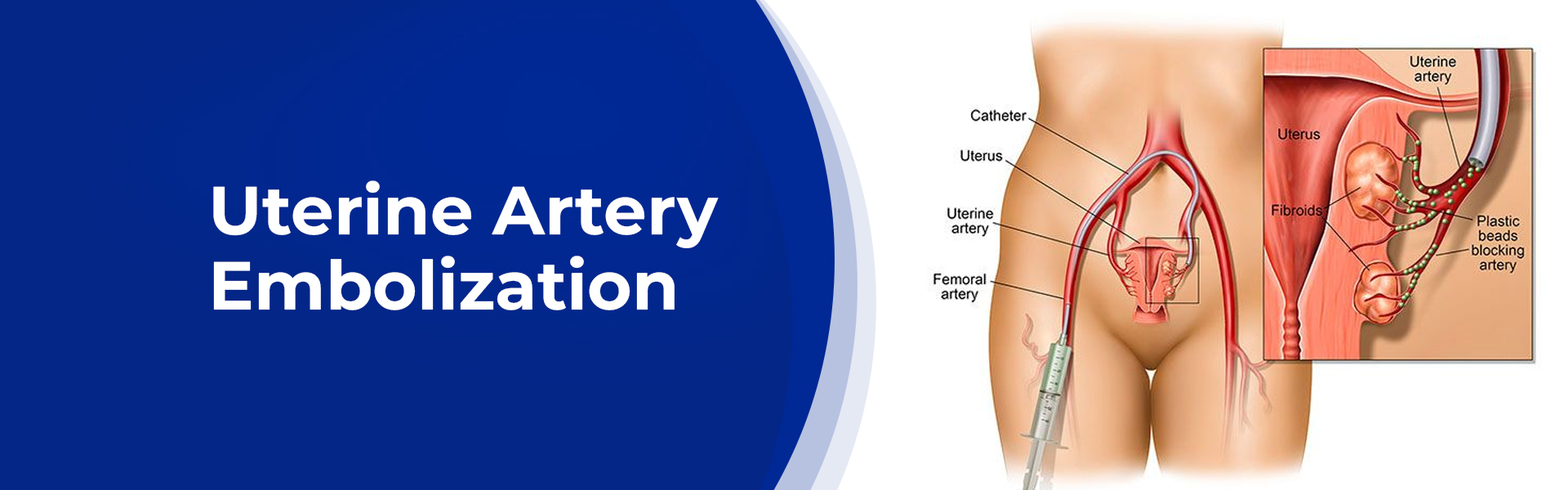 Urinary Artery Embolization – A Quick Guide
