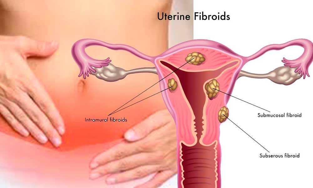 Getting Treated for Fibroid Cases